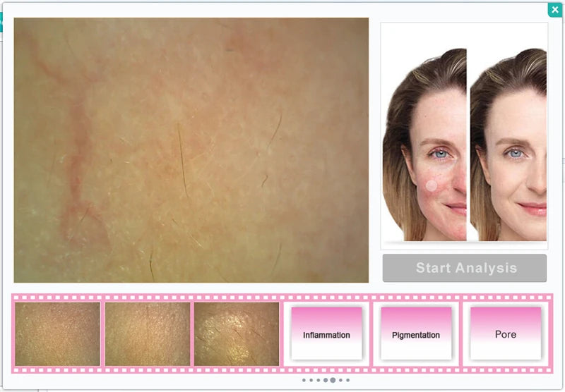 Skin analysis software interface with skin texture and two faces for comparison.